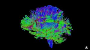 Brain Surgery Solution Brings Canadian High Tech Company Life Science Award